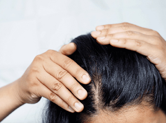 L'alopécie : causes, solutions et conseils pour mieux la vivre