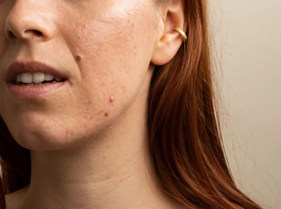 Peau et intestins sont étroitement liés : ce que vous devez savoir