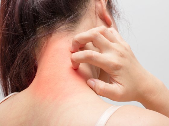 6 médecines douces pour soulager efficacement l'eczéma