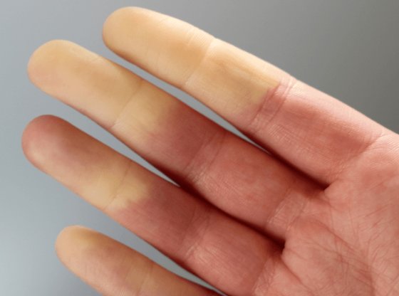 Syndrome de Raynaud : les symptômes à surveiller et comment s'en protéger