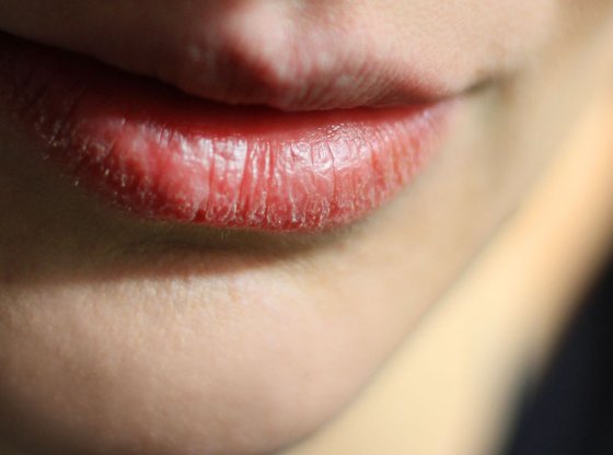 Solutions naturelles contre les lèvres gercées : dites adieu aux fissures !