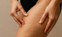 Cellulite des cuisses : les vraies méthodes qui marchent enfin