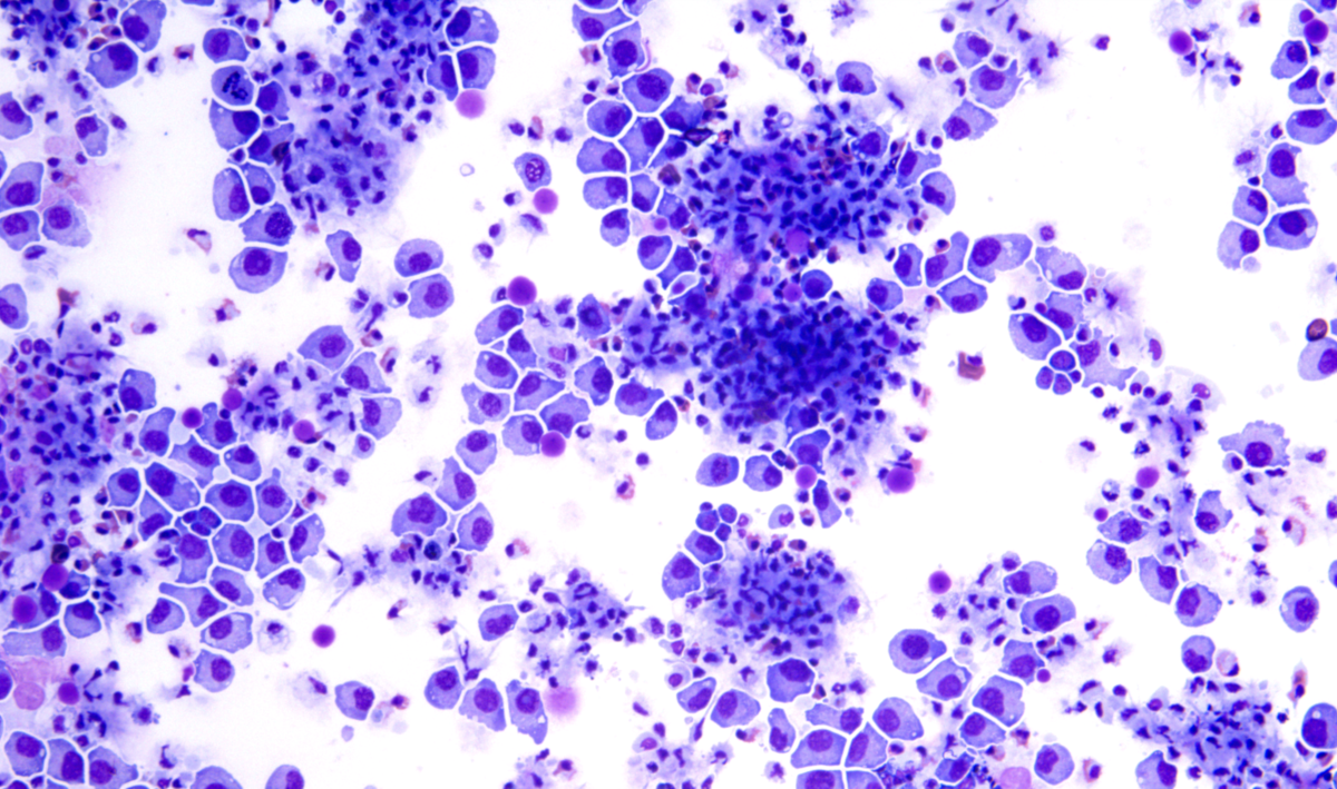 Journée mondiale contre le cancer : pourquoi les jeunes sont de plus en plus touchés