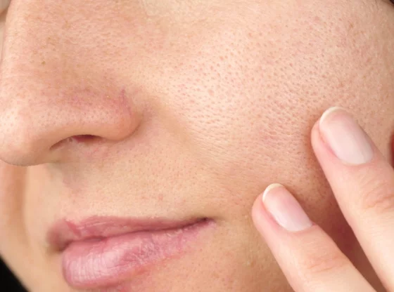 Réguler le sébum : astuces incontournables pour un teint parfait